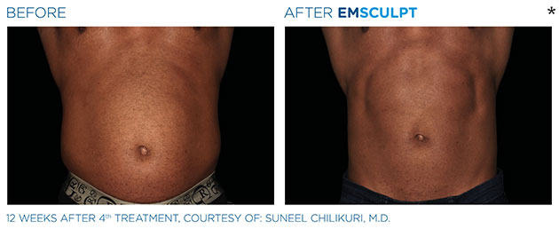 Before and After Photo of abdomen scultping Treatment in San Francisco